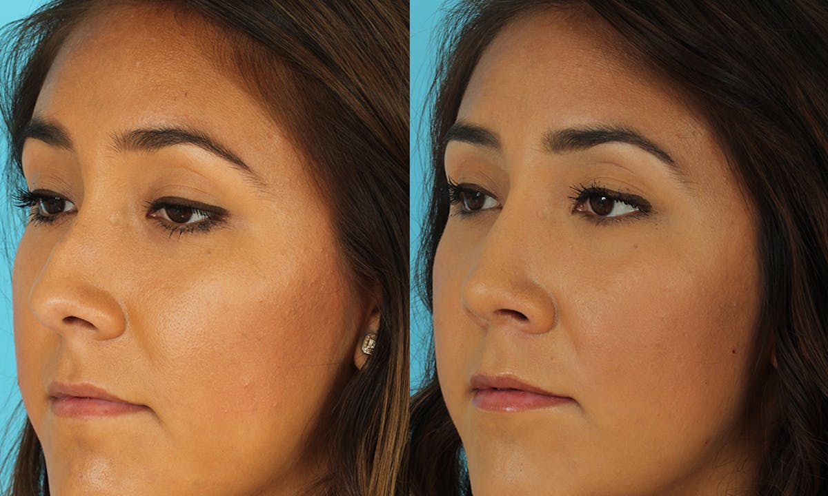 Rhinoplasty Before & After Gallery - Patient 183963 - Image 1