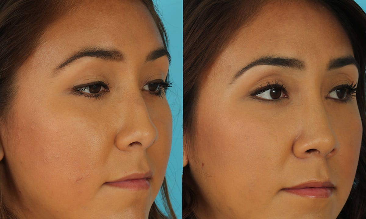 Rhinoplasty Before & After Gallery - Patient 183963 - Image 2