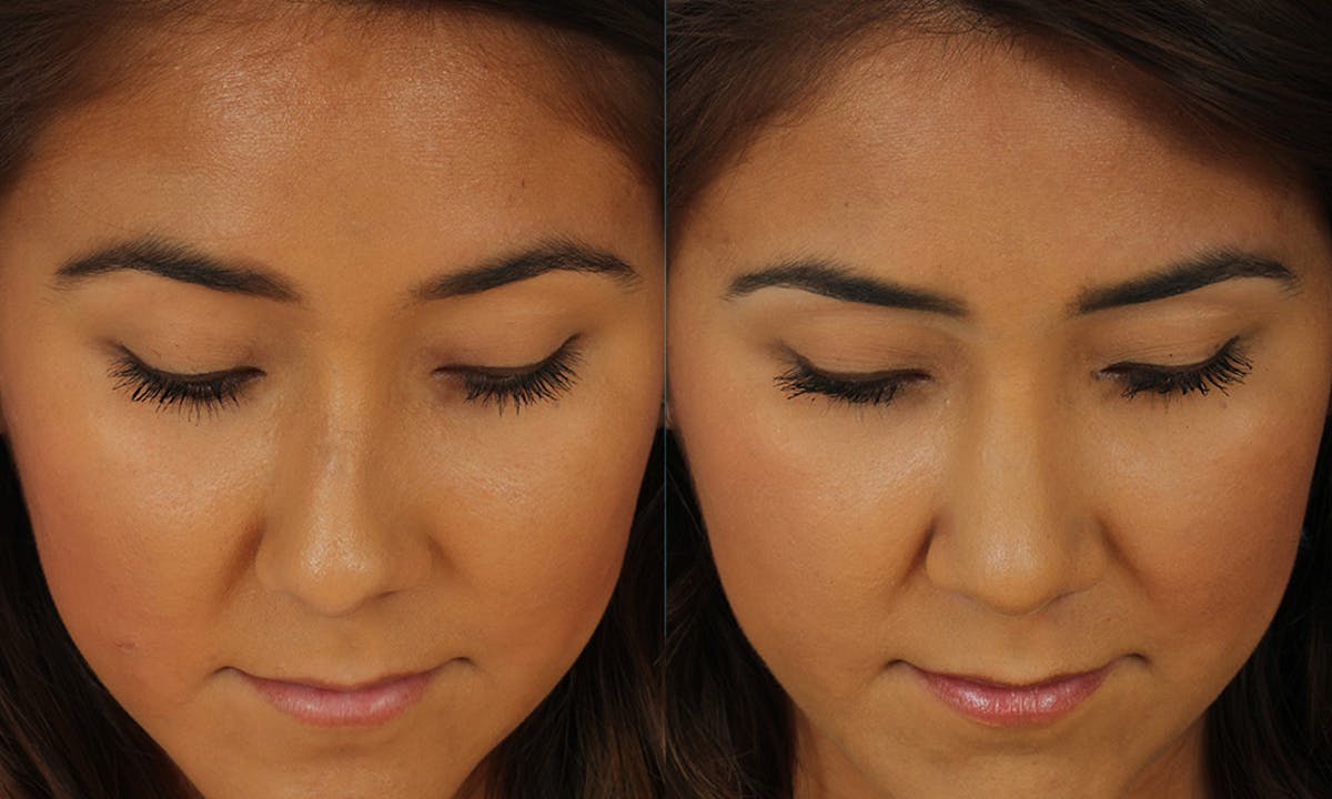Rhinoplasty Before & After Gallery - Patient 183963 - Image 3