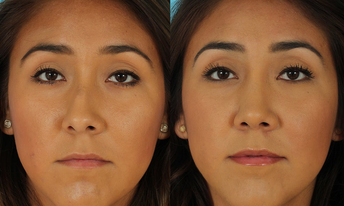 Rhinoplasty Before & After Gallery - Patient 183963 - Image 4