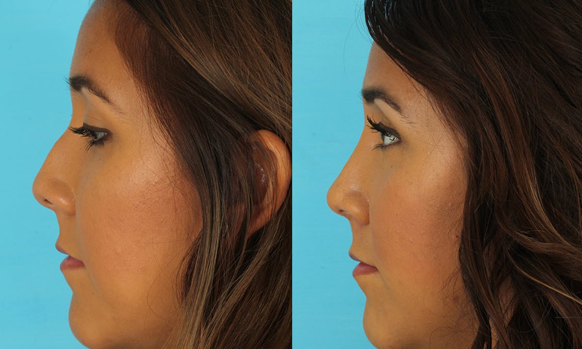 Rhinoplasty Before & After Gallery - Patient 183963 - Image 5