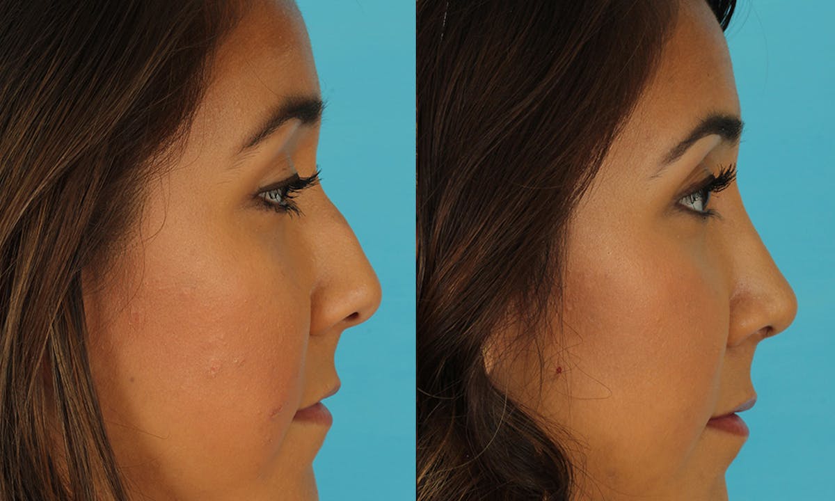Rhinoplasty Before & After Gallery - Patient 183963 - Image 6