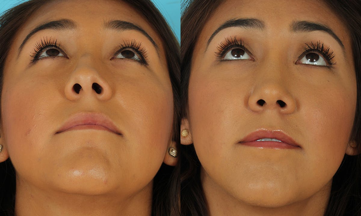 Rhinoplasty Before & After Gallery - Patient 183963 - Image 7