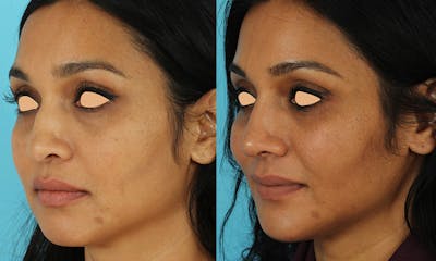 Rhinoplasty Before & After Gallery - Patient 249269 - Image 1