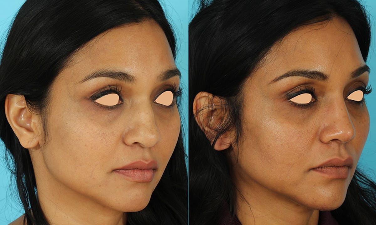 Rhinoplasty Before & After Gallery - Patient 249269 - Image 2