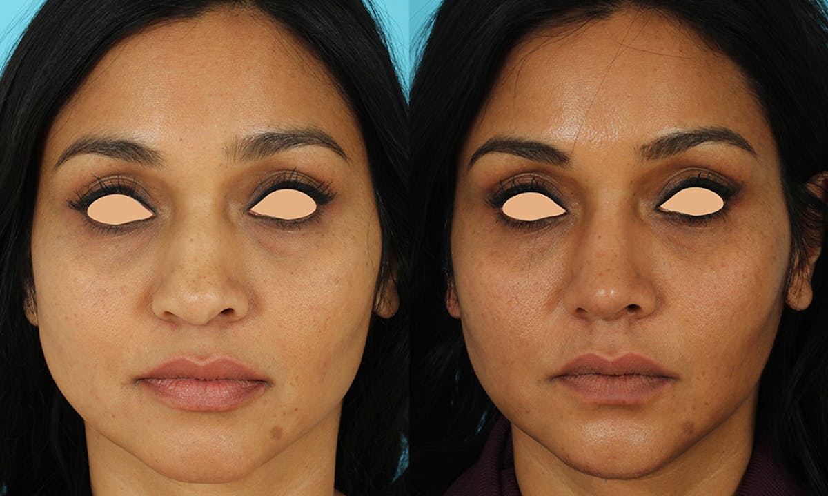 Rhinoplasty Before & After Gallery - Patient 249269 - Image 3