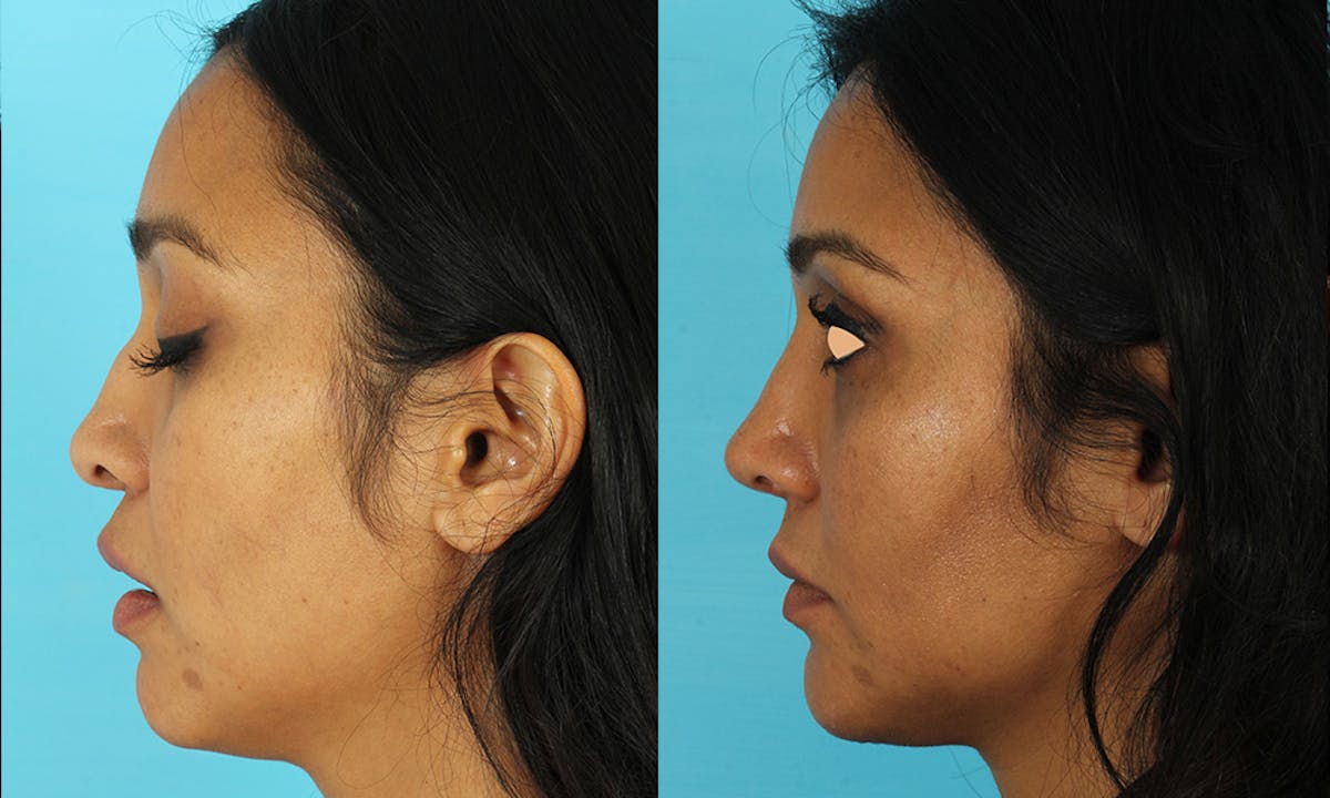 Rhinoplasty Before & After Gallery - Patient 249269 - Image 4