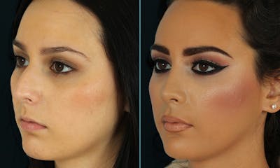Rhinoplasty Before & After Gallery - Patient 629374 - Image 1