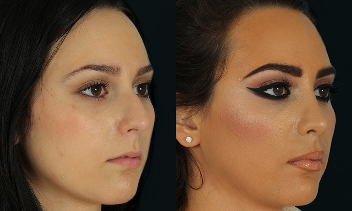 Rhinoplasty Before & After Gallery - Patient 629374 - Image 2