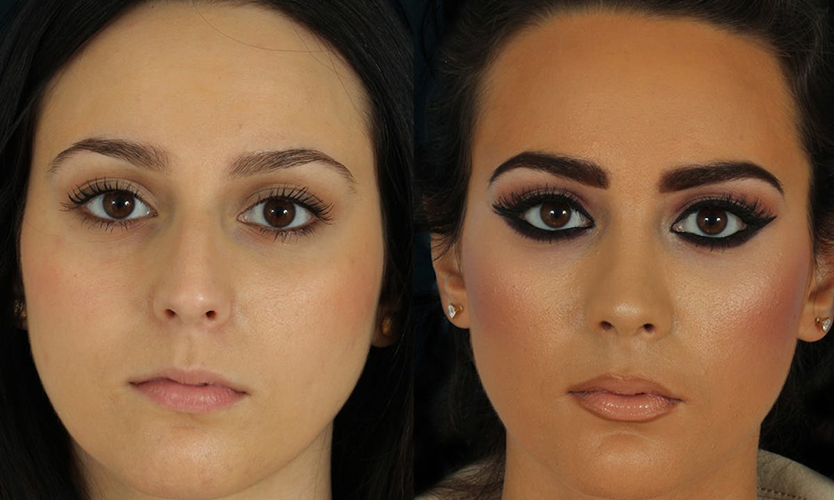 Rhinoplasty Before & After Gallery - Patient 629374 - Image 3