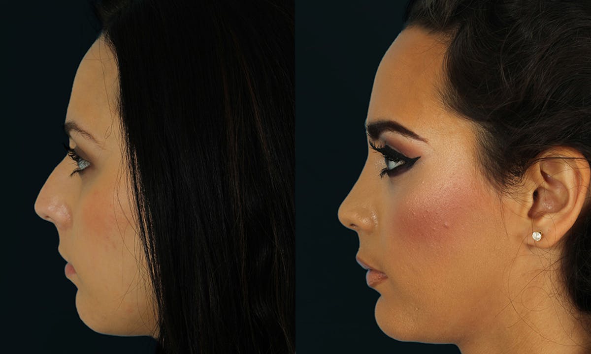 Rhinoplasty Before & After Gallery - Patient 629374 - Image 4