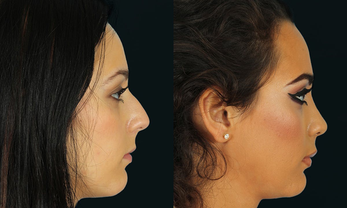 Rhinoplasty Before & After Gallery - Patient 629374 - Image 5
