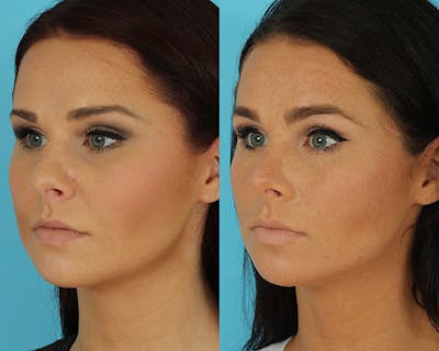 Rhinoplasty Before & After Gallery - Patient 339357 - Image 1