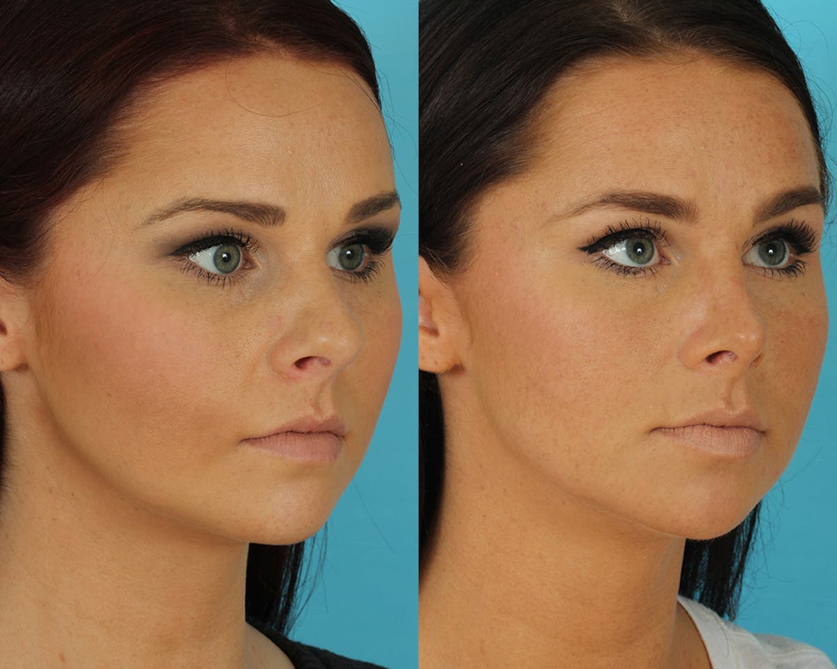 Rhinoplasty Before & After Gallery - Patient 339357 - Image 2