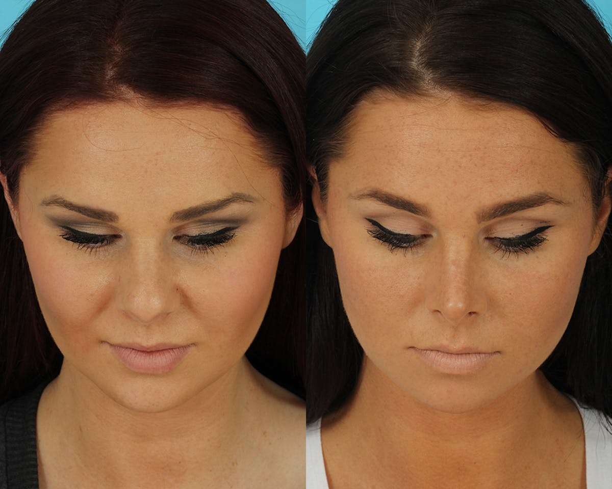 Rhinoplasty Before & After Gallery - Patient 339357 - Image 3