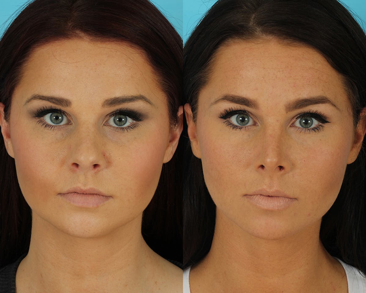 Rhinoplasty Before & After Gallery - Patient 339357 - Image 4