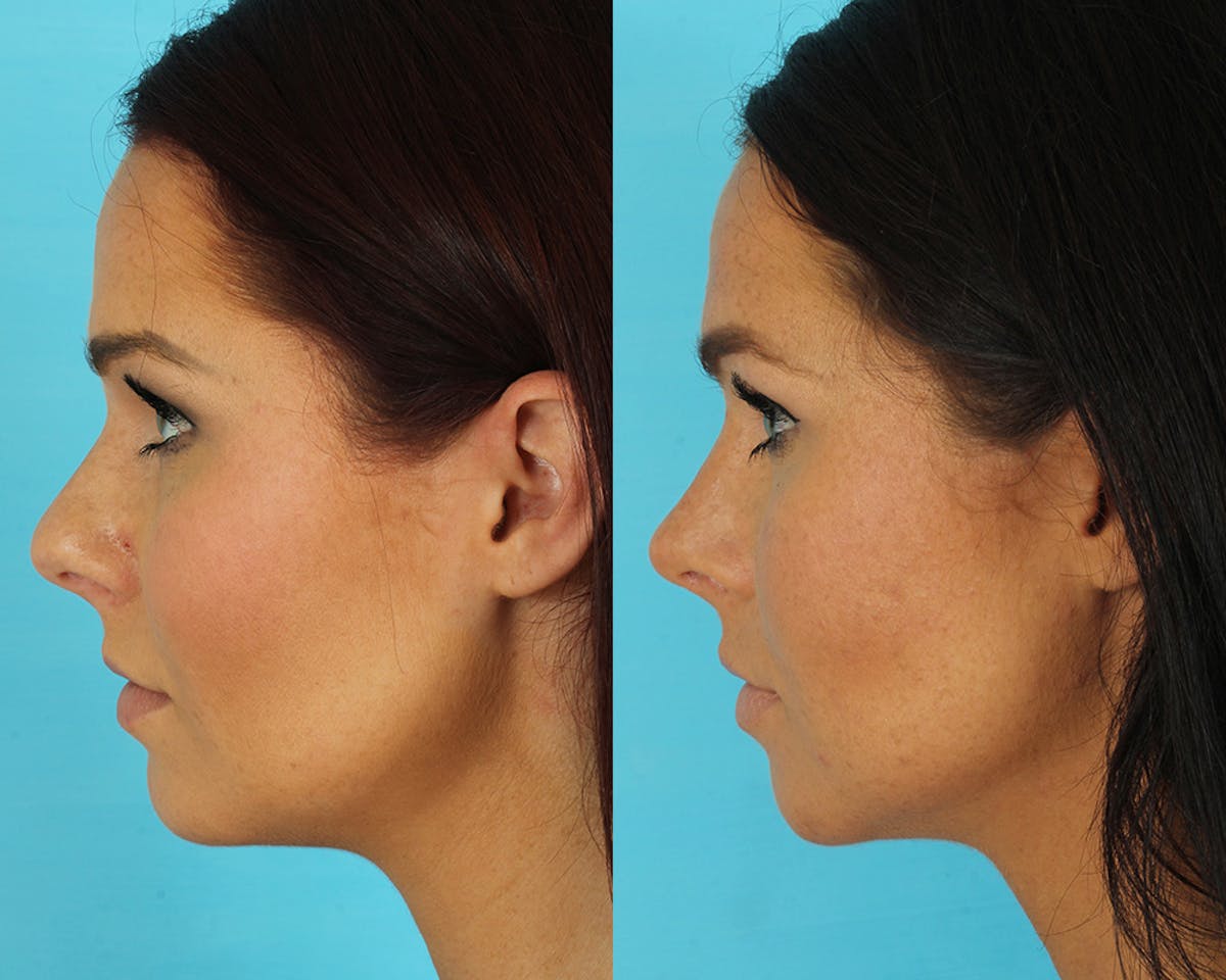 Rhinoplasty Before & After Gallery - Patient 339357 - Image 5