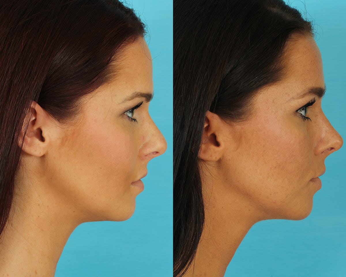Rhinoplasty Before & After Gallery - Patient 339357 - Image 6
