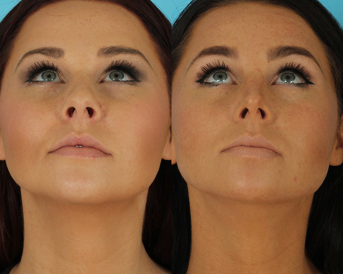 Rhinoplasty Before & After Gallery - Patient 339357 - Image 7