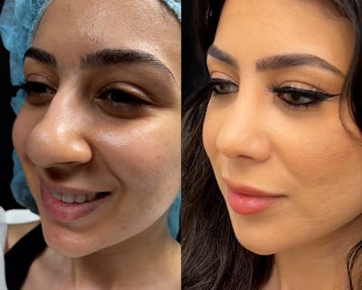 Rhinoplasty Before & After Gallery - Patient 758767 - Image 1