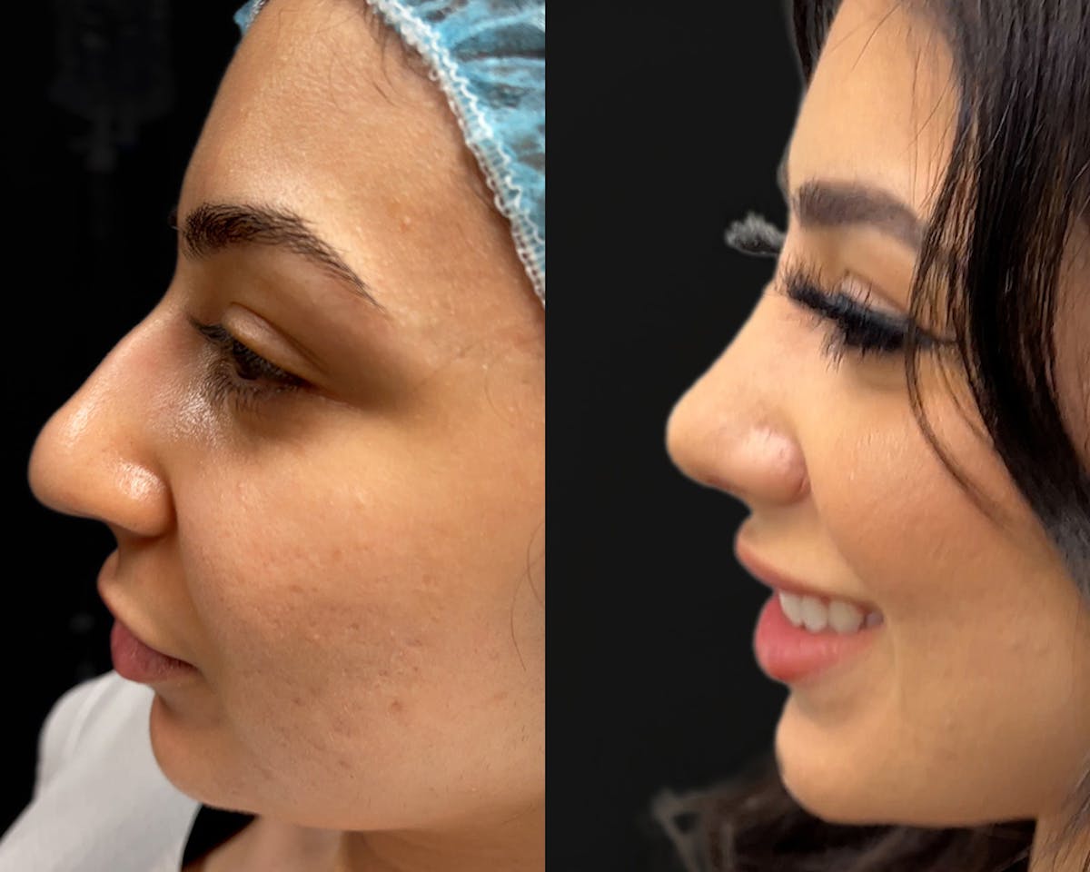 Rhinoplasty Before & After Gallery - Patient 758767 - Image 2