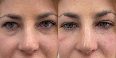 BOTOX Fillers Before & After Gallery - Patient 258770 - Image 1