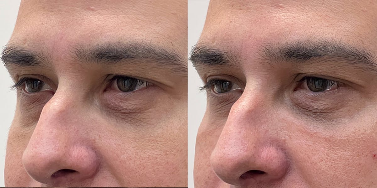 BOTOX Fillers Before & After Gallery - Patient 125435 - Image 1