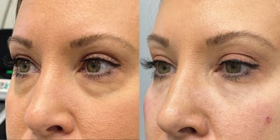 BOTOX Fillers Before & After Gallery - Patient 326130 - Image 1
