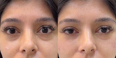BOTOX Fillers Before & After Gallery - Patient 637973 - Image 1
