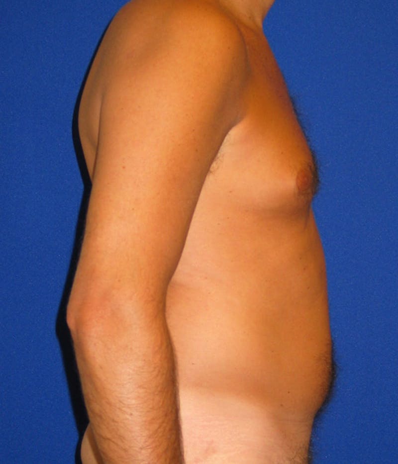 Liposuction Before & After Gallery - Patient 175168838 - Image 3