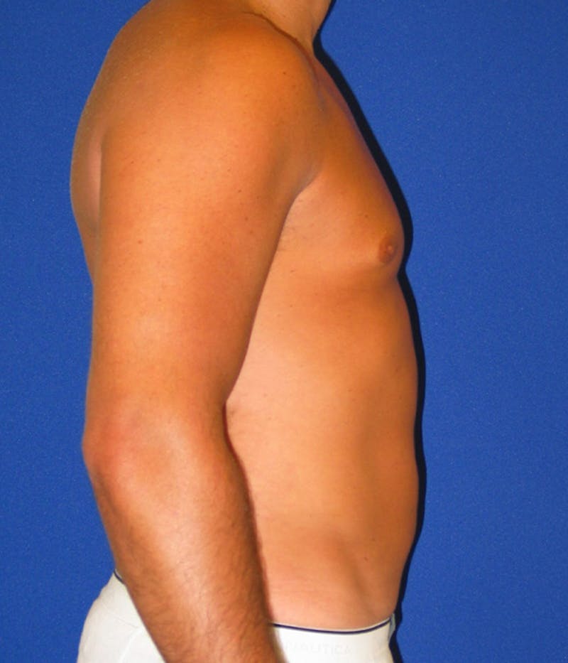 Liposuction Before & After Gallery - Patient 175168838 - Image 4