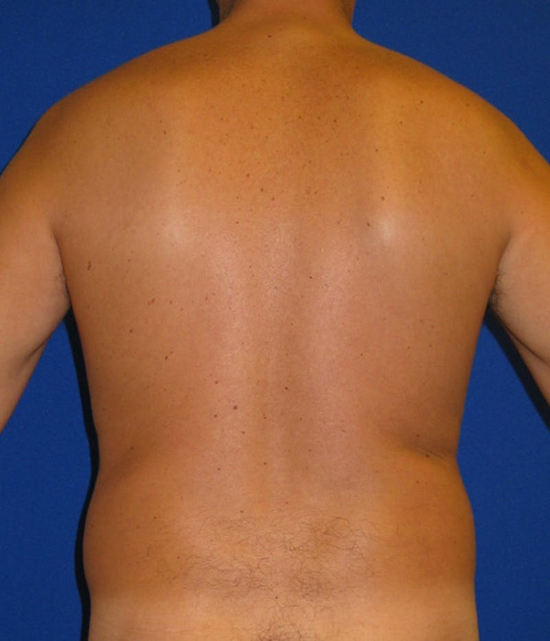 Liposuction Before & After Gallery - Patient 175168838 - Image 5