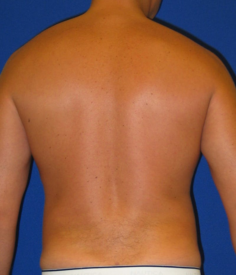 Liposuction Before & After Gallery - Patient 175168838 - Image 6