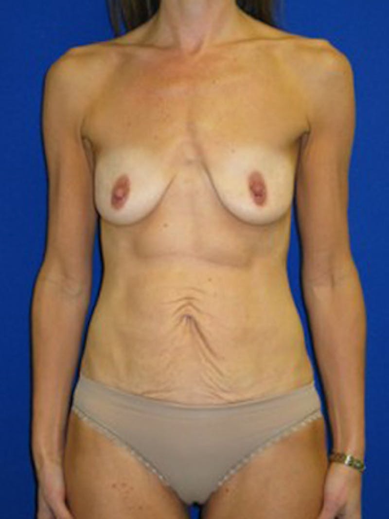 Mommy Makeover Before & After Gallery - Patient 175168974 - Image 1