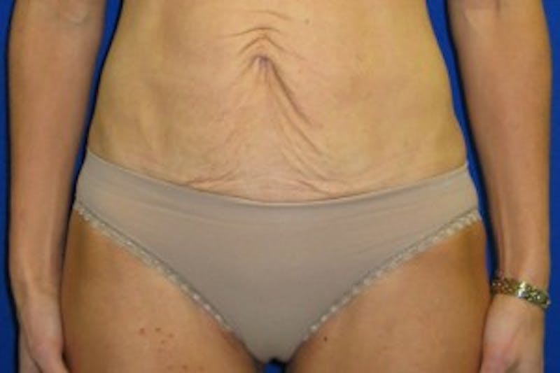 Mini Abdominoplasty Before & After Gallery - Patient 175168973 - Image 3