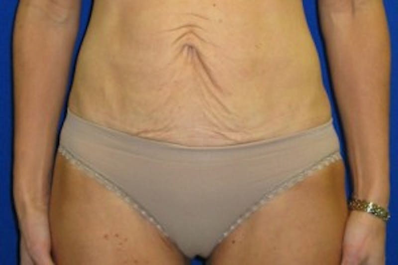 Mommy Makeover Before & After Gallery - Patient 175168974 - Image 3