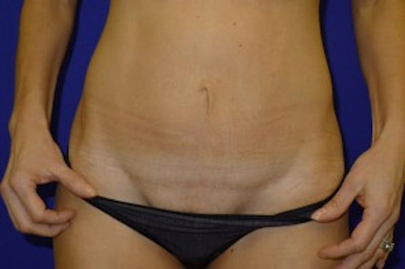 Mini Abdominoplasty Before & After Gallery - Patient 175168973 - Image 4