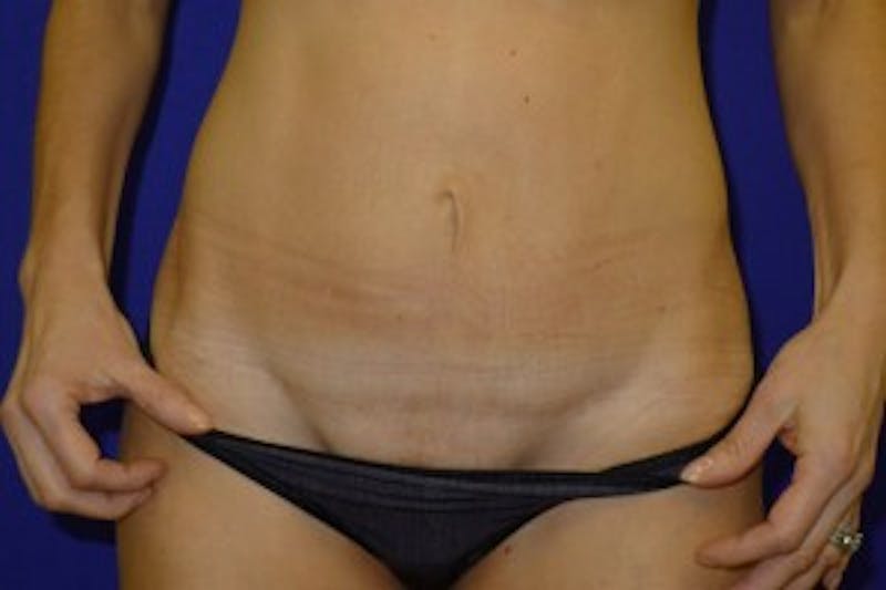 Mommy Makeover Before & After Gallery - Patient 175168974 - Image 4