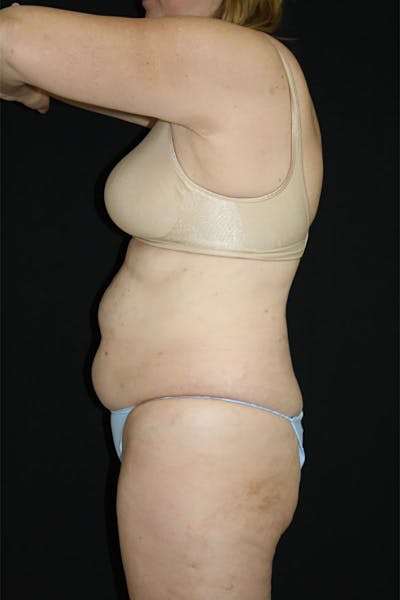 CoolSculpting Before & After Gallery - Patient 175168983 - Image 1