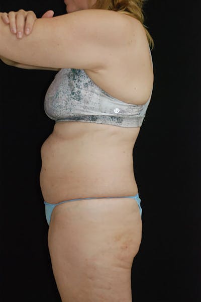 CoolSculpting Before & After Gallery - Patient 175168983 - Image 2