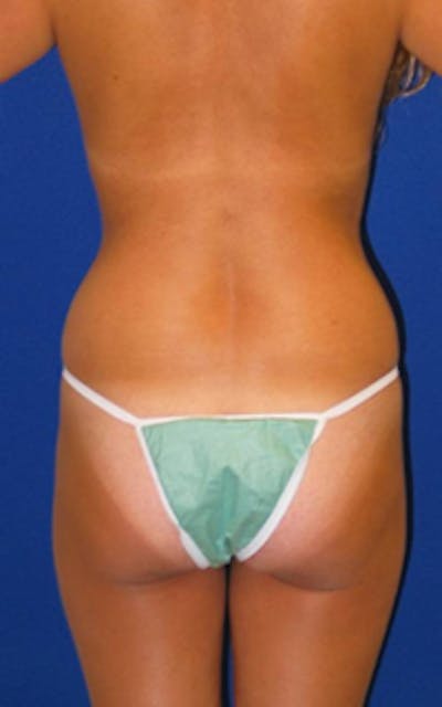 Liposuction Before & After Gallery - Patient 175169012 - Image 1
