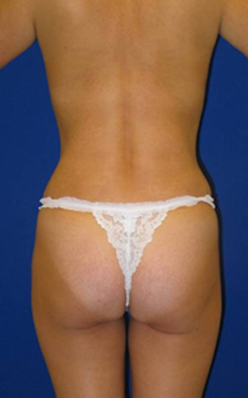 Liposuction Before & After Gallery - Patient 175169012 - Image 2