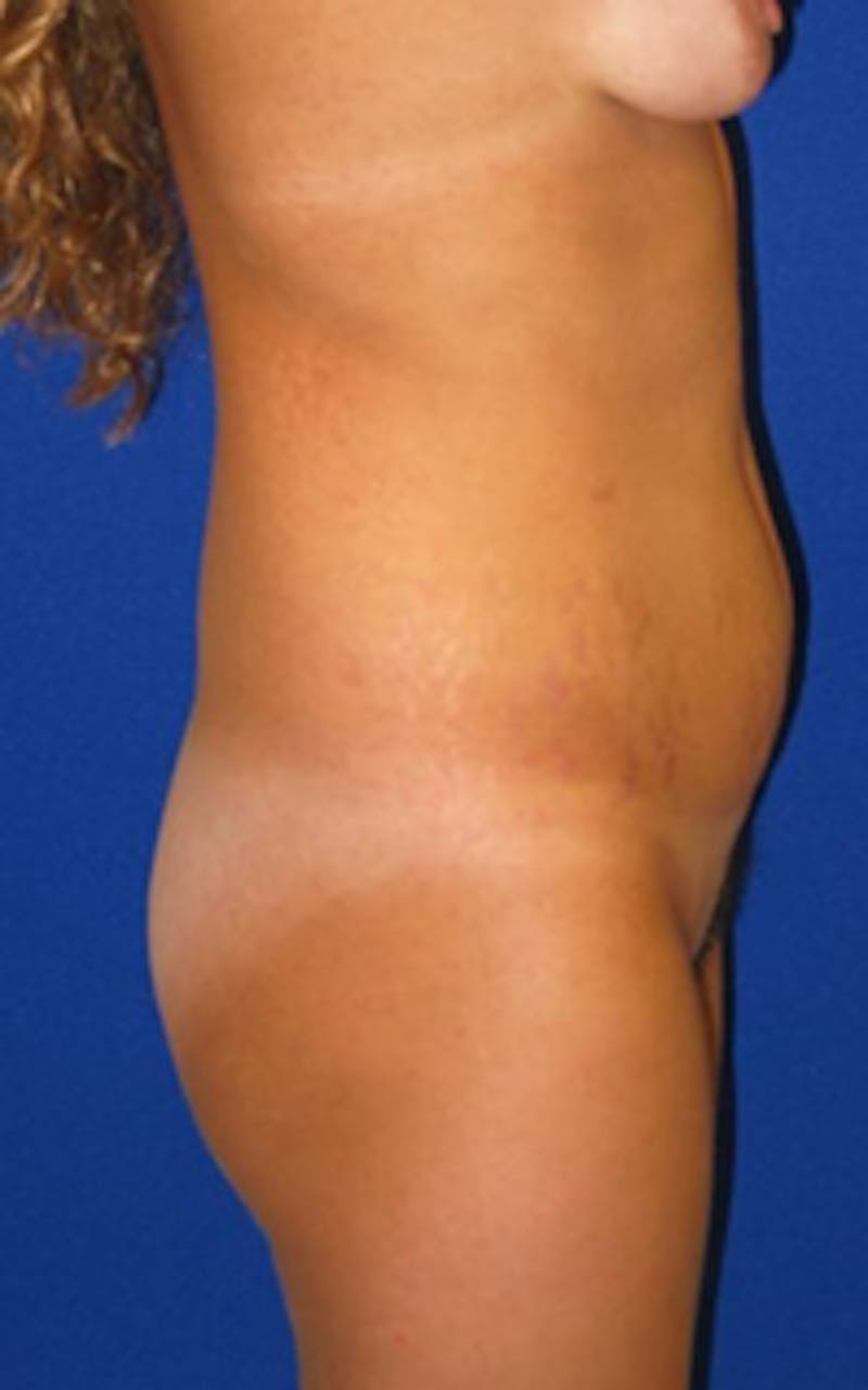 Liposuction Before & After Gallery - Patient 175169012 - Image 3