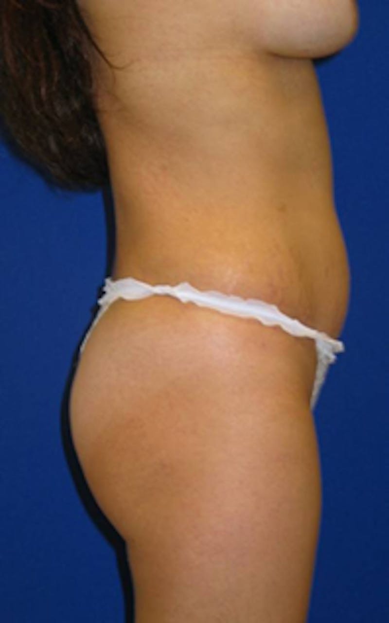 Liposuction Before & After Gallery - Patient 175169012 - Image 4