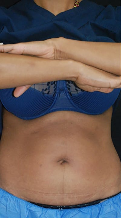 CoolSculpting Before & After Gallery - Patient 175169017 - Image 1