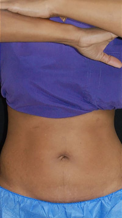 CoolSculpting Before & After Gallery - Patient 175169017 - Image 2