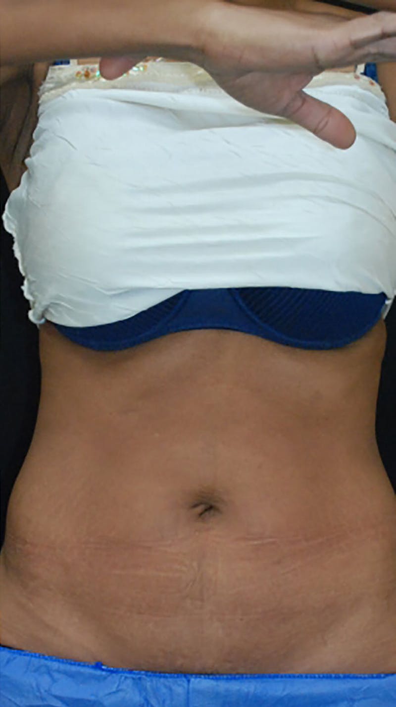 CoolSculpting Before & After Gallery - Patient 175169017 - Image 4