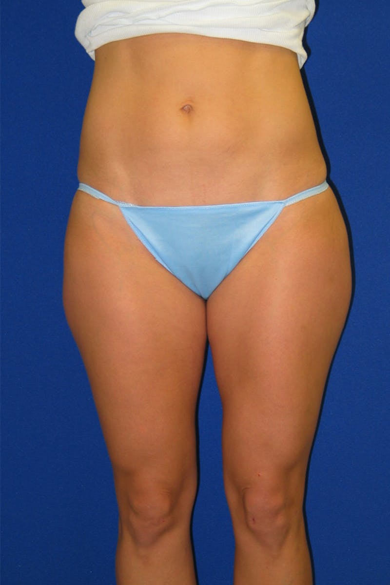 Mommy Makeover Before & After Gallery - Patient 175169039 - Image 5