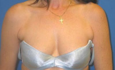 Liposuction Before & After Gallery - Patient 175169036 - Image 1