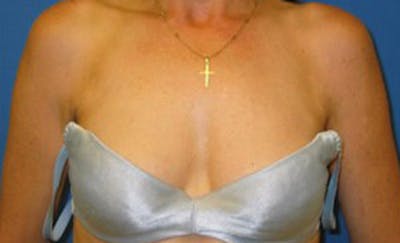 Liposuction Before & After Gallery - Patient 175169036 - Image 2